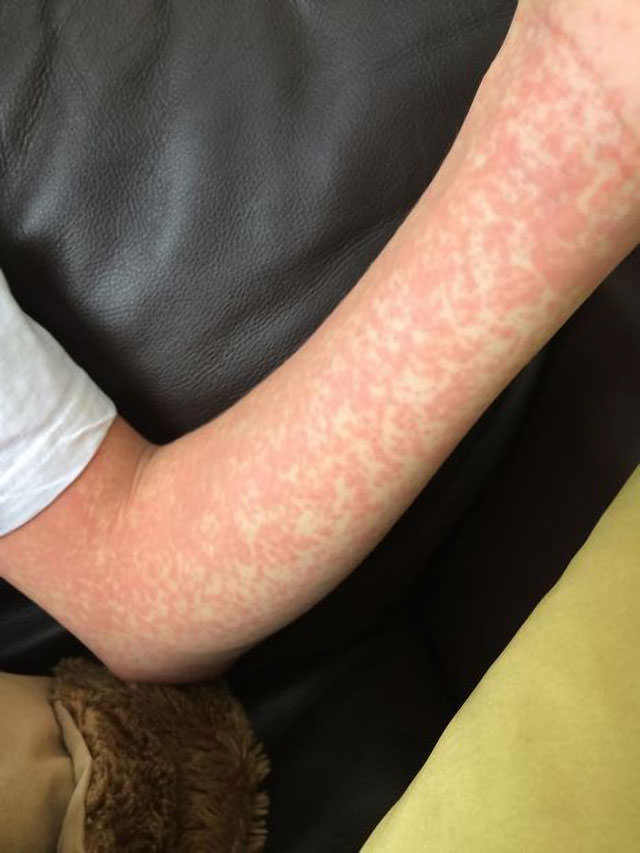 My Sons' Vaccine-Related Measles 4